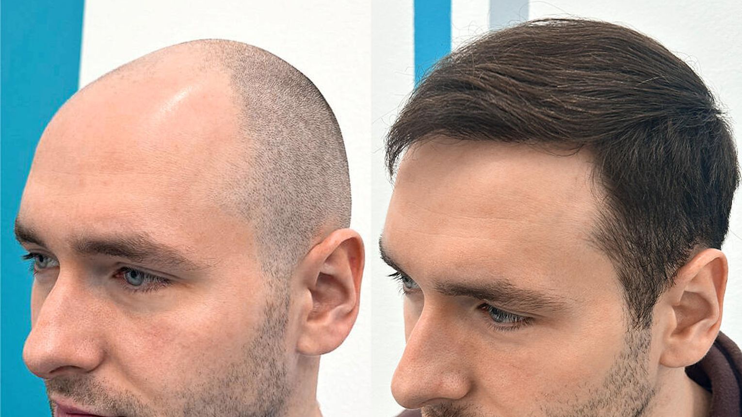 Przeszczep włosów w Krakowie – czy mieszkańcy Małopolski muszą wyjeżdżać za granicę? FullFace Clinic wyjaśnia