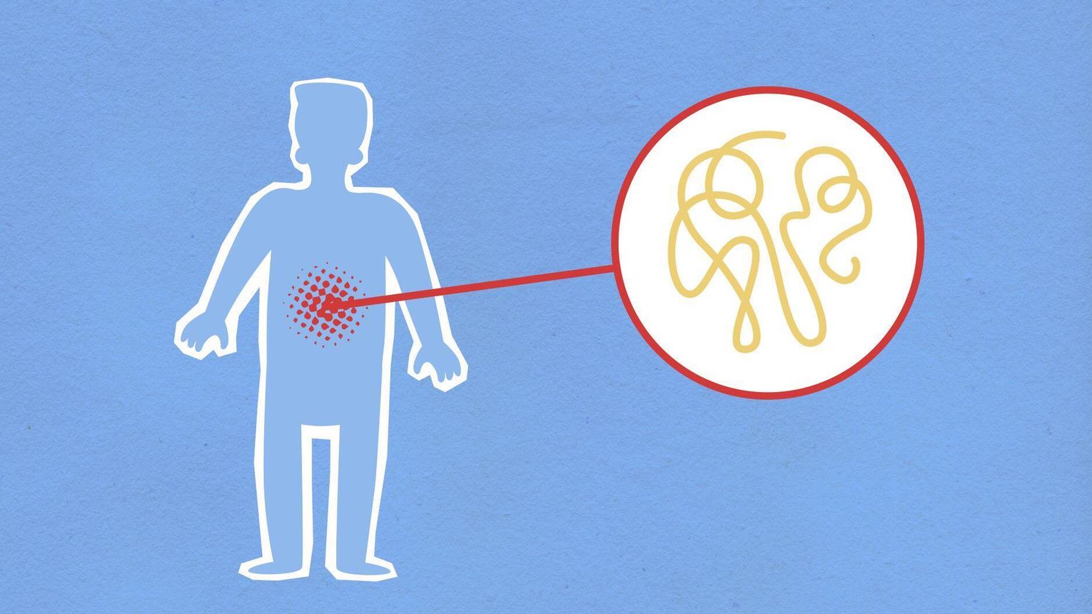 Wynik testu na Helicobacter pylori jest dodatni. Co dalej?
