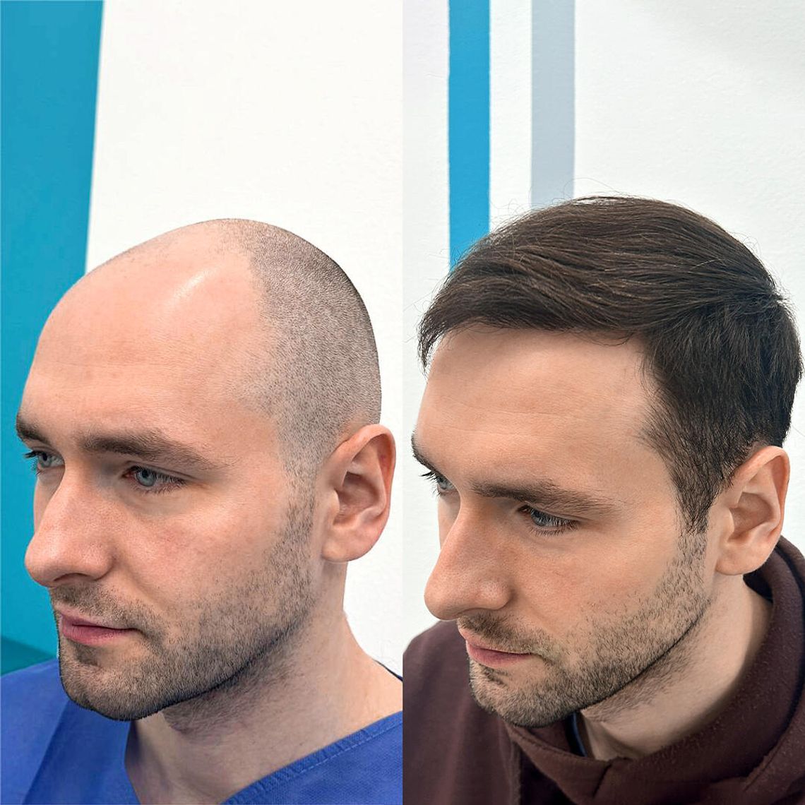 Przeszczep włosów w Krakowie – czy mieszkańcy Małopolski muszą wyjeżdżać za granicę? FullFace Clinic wyjaśnia